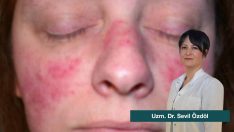 Bahar Aylarında Gül Hastalığına Dikkat!