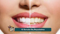 10 Soruda Diş Beyazlatma